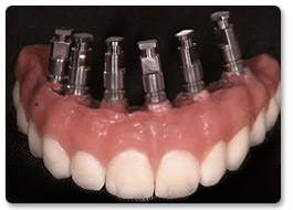 Beispiel Implantat