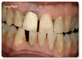 Beispiel Implantat