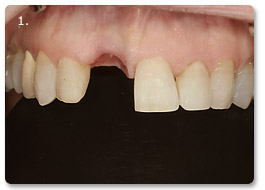 Beispiel Implantat