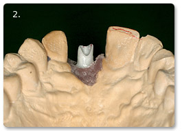 Beispiel Implantat