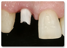 Beispiel Implantat