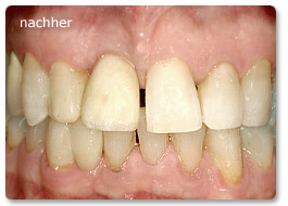 Beispiel Implantat