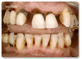 Beispiel Implantat