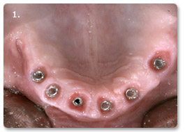 Beispiel Implantat