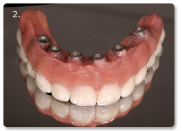 Beispiel Implantat