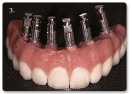 Beispiel Implantat