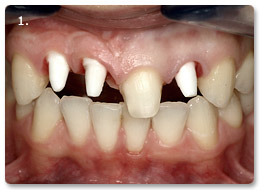 Beispiel Implantat