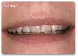 Beispiel Veneer