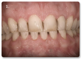 Beispiel Veneer