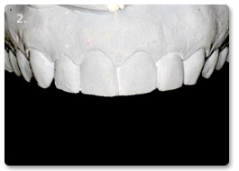 Beispiel Veneer
