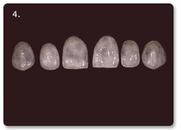 Beispiel Veneer