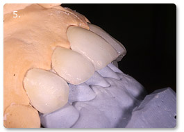 Beispiel Veneer