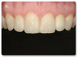 Beispiel Veneer