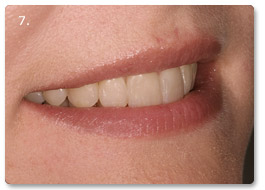 Beispiel Veneer