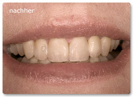 Beispiel Veneer