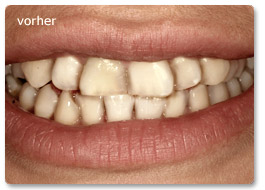 Beispiel Veneer