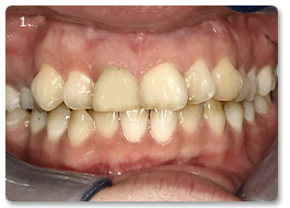 Beispiel Veneer