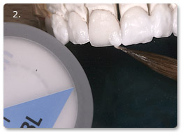 Beispiel Veneer