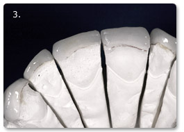 Beispiel Veneer