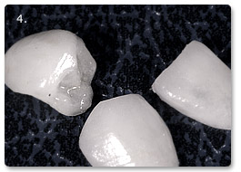 Beispiel Veneer