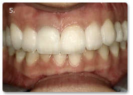 Beispiel Veneer
