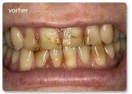 Beispiel Veneer