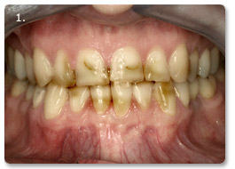 Beispiel Veneer