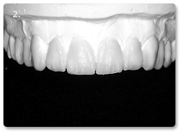 Beispiel Veneer