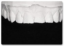 Beispiel Veneer