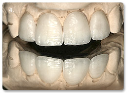 Beispiel Veneer