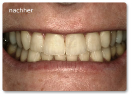 Beispiel Veneer